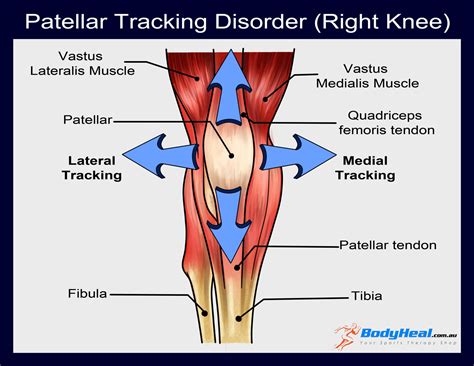 the patella should track over